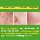 Kit Skincare Anti Oleosidade e Acne Salicílico + Sérum Secativo Dermachem